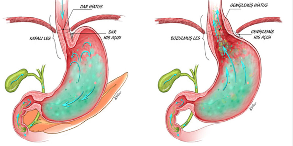 alkalen reflü gastrit