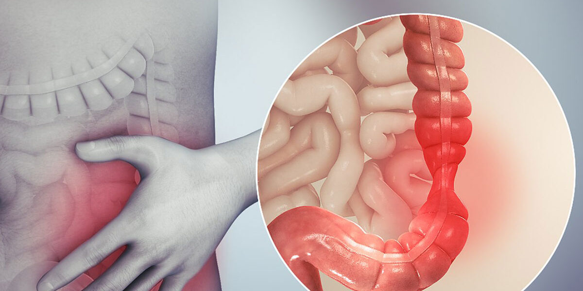 IBS Krankheitsbehandlung - Reizdarmsyndrom