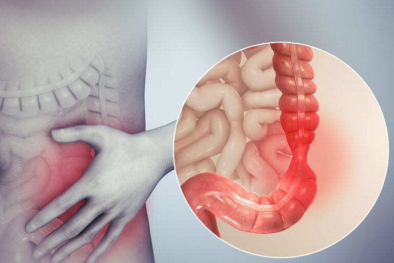 IBS Krankheitsbehandlung - Reizdarmsyndrom