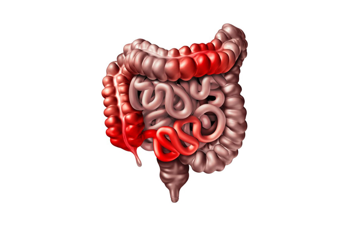 Was ist Morbus Crohn und wie wird er behandelt?