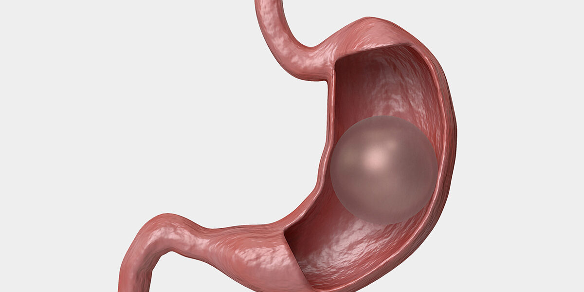 Gastric Balloon Prices 2024