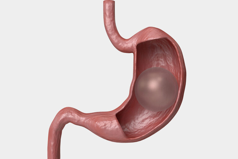 Gastric Balloon Prices 2024